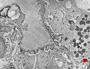 M,13y. | thin basement membrane syndrome